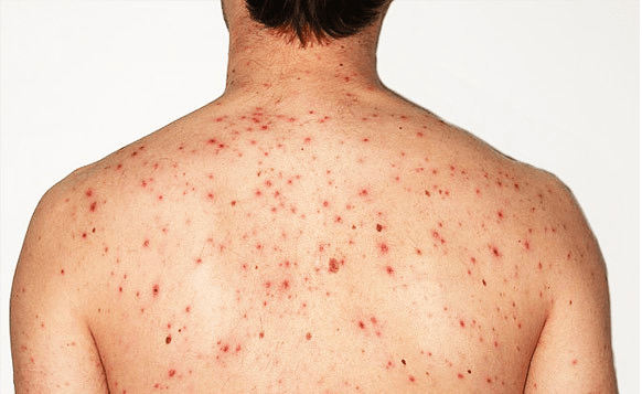 Penyebab Jerawat di Badan