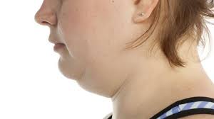 double chin